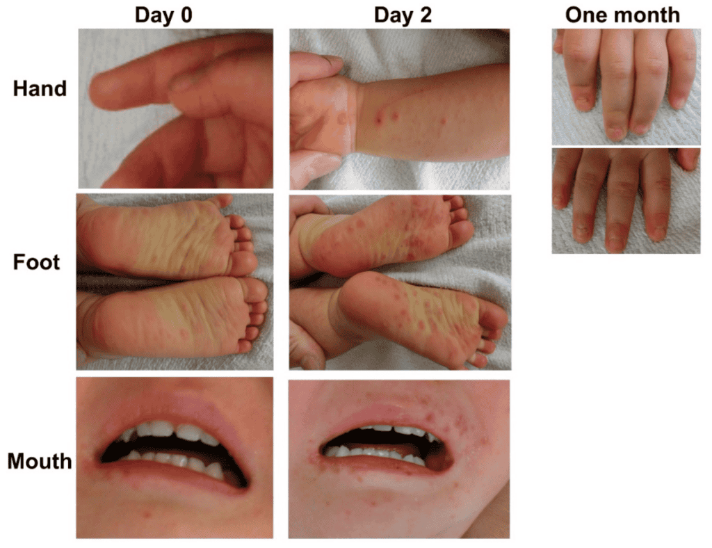 Progression of Hand Foot Mouth Disease is shown on hands, feet, and mouth over time: Day 0, Day 2, and one month.