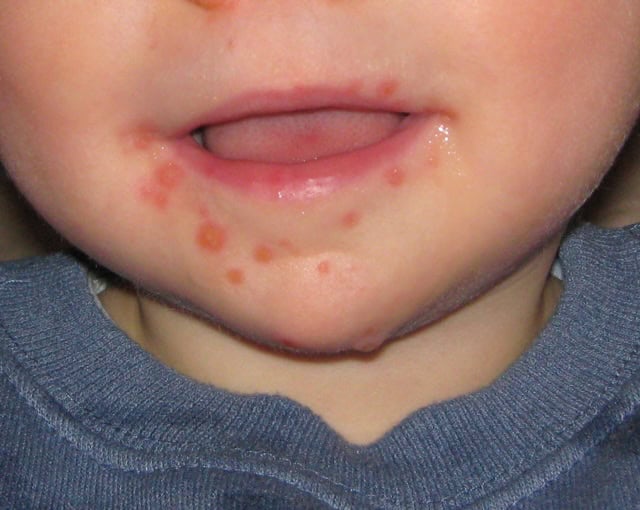 Close-up of a child's mouth with HFM Disease