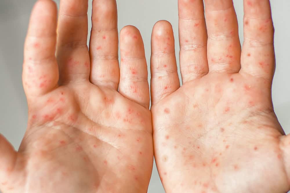 Close-up of a child's hands with HFM Disease