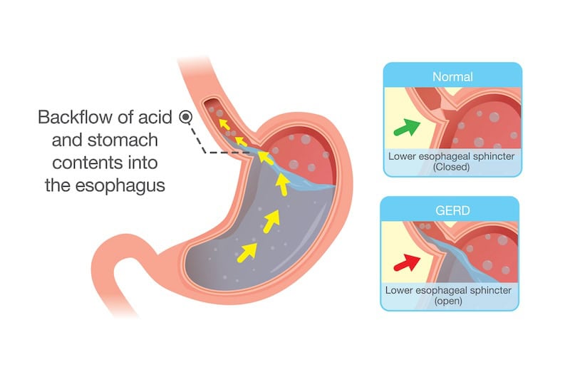 Acid in stomach back up into esophagus