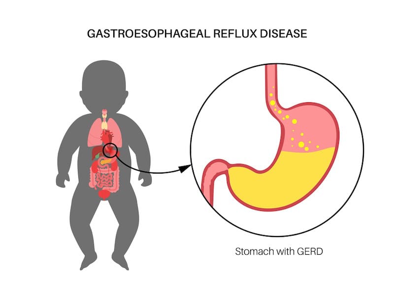 GERD in infant baby